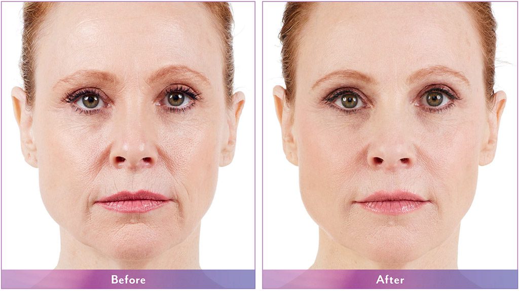 Juvéderm® Family Suh Esthetics